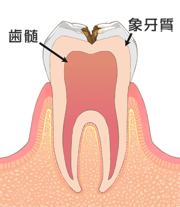 象牙質の虫歯（C2）、骨髄、象牙質