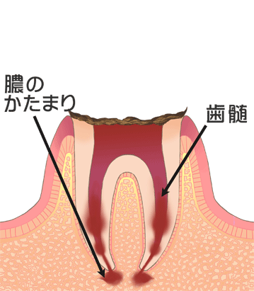 末期の虫歯（C4）膿の塊、歯髄