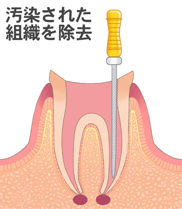 汚染組織を除去