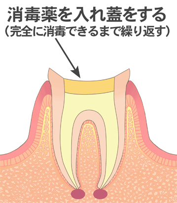 消毒薬を入れ蓋をする（完全に消毒できるまで繰り返す）