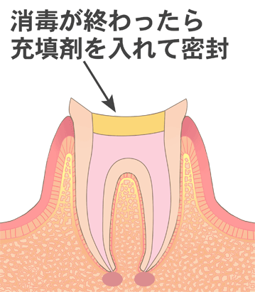 消毒が終わったら充填剤を入れて密封