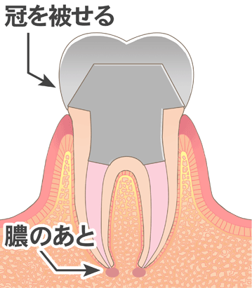 冠を被せる、膿のあと