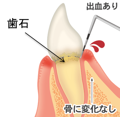 歯を失う一番の病気です、歯石、出血あり、骨に変化なし