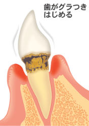 歯を失う一番の病気です、歯がぐらつき始める