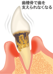 歯を失う一番の病気です、歯槽骨で歯を支えられなくなる